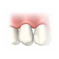  Einsetzung des Zahnersatzes in den Mund