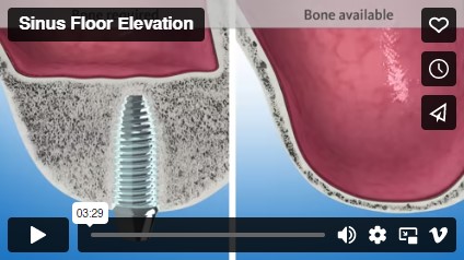 Sinus floor elevation