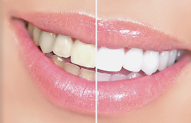 Dent-A-Lux - Zahnbleichen Kecskemét